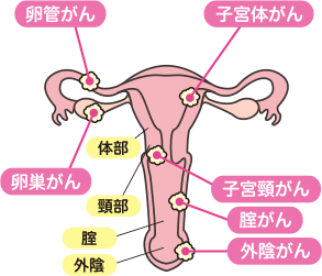 卵管がん・卵巣がん・子宮体がん・子宮頸がん・膣がん・外陰がん | 体部・頸部・膣・外陰