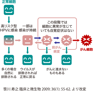 正常細胞→高リスク型HPVに感染(→多くの場合自然に排除される)→一部は感染が持続(→ウイルスが排除されれば正常に戻る)→前がん病変・この段階では細胞に異常が生じていても自覚症状はない(→がんに進まないものもある)→がん細胞 | 笹川 寿之 臨床と微生物 2009; 36(1): 55-62. より改変
