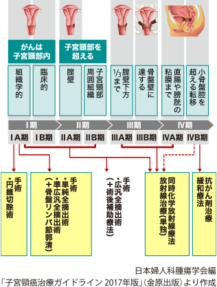 子宮頸がんステージ別治療法:ⅠA期(組織学的)・ⅠB期(臨床的)・ⅡA期(膣壁)・ⅡB期(子宮頸部周辺組織)・ⅢA期(膣壁下方1/3まで)・ⅢB期(骨盤壁に達する)・ⅣA期(直腸や膀胱の粘膜まで)・ⅣB期(小骨盤膣を超える転移) | 手術(円錐切除術):ⅠA期、手術(単純全摘出術・準広汎全摘出術(+骨盤リンパ半郭清):ⅠA期、手術(広汎全摘出術(+術後補助療法)):ⅠA期~ⅡB期、同時化学放射線療法/放射線治療(単独):ⅠA期~ⅣA期(ⅣB期)、抗がん剤治療/緩和療法(ⅣB期) | 日本婦人科腫瘍学会編「子宮頸癌治療ガイドライン 2017年版」(金原出版)より作成