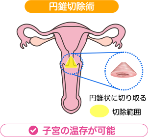 子宮頸前がん病変やごく初期のがんに対する治療方法：円錐切除術 | 円錐状に切り取る | 子宮の温存が可能