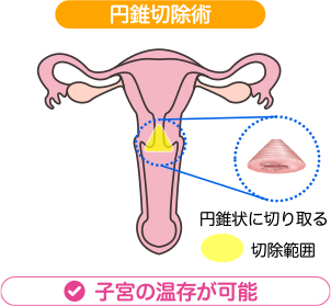 子宮頸前がん病変やごく初期のがんに対する治療方法:円錐切除術 | 円錐状に切り取る | 子宮の温存が可能