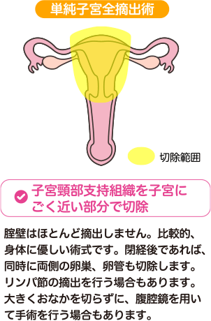 ステージが進んだがんに対する治療方法:単純子宮全摘出術 | 子宮頸部支持組織を子宮にごく近い部分で切除 | 膣壁はほとんど摘出しません。比較的、身体に優しい術式です。閉経後であれば、同時に両側の卵巣、卵管も切除します。リンパ節の摘出を行う場合もあります。大きくおなかを切らずに、腹腔鏡を用いて手術を行う場合もあります。