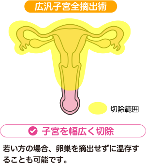 さらに進行したがんに対する治療方法：広汎子宮全摘出術 | 子宮を幅広く切除 | 若い方の場合、卵巣を摘出せずに温存することも可能です。