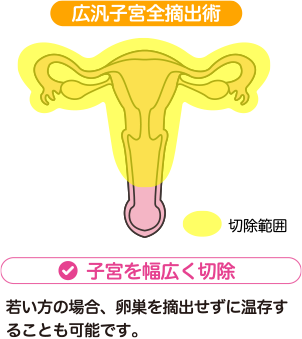 さらに進行したがんに対する治療方法:広汎子宮全摘出術 | 子宮を幅広く切除 | 若い方の場合、卵巣を摘出せずに温存することも可能です。