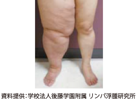 リンパ浮腫 | 資料提供:学校法人後藤学園付属 リンパ浮腫研究所