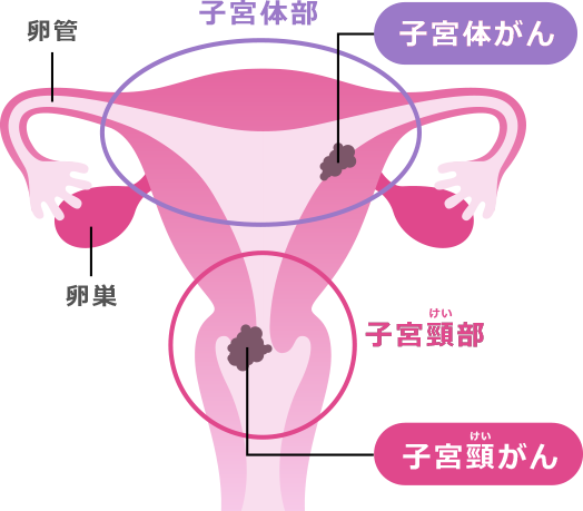 子宮がんは、「がん」が発生する場所によって2種類あります：子宮体部ー子宮体がん | 子宮頚部ー子宮頸がん