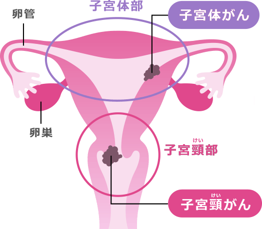 子宮がんは、「がん」が発生する場所によって2種類あります：子宮体部ー子宮体がん | 子宮頚部ー子宮頸がん