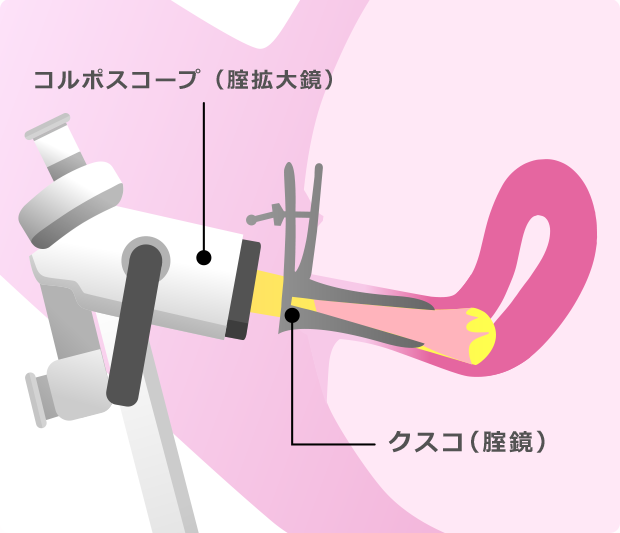 コルポスコープ(膣拡大鏡)| クスコ(膣鏡)