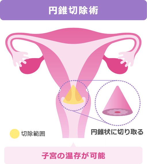 子宮頸前がん病変やごく初期のがんに対する治療方法：円錐切除術 | 切除範囲を円錐状に切り取る | 子宮の温存が可能