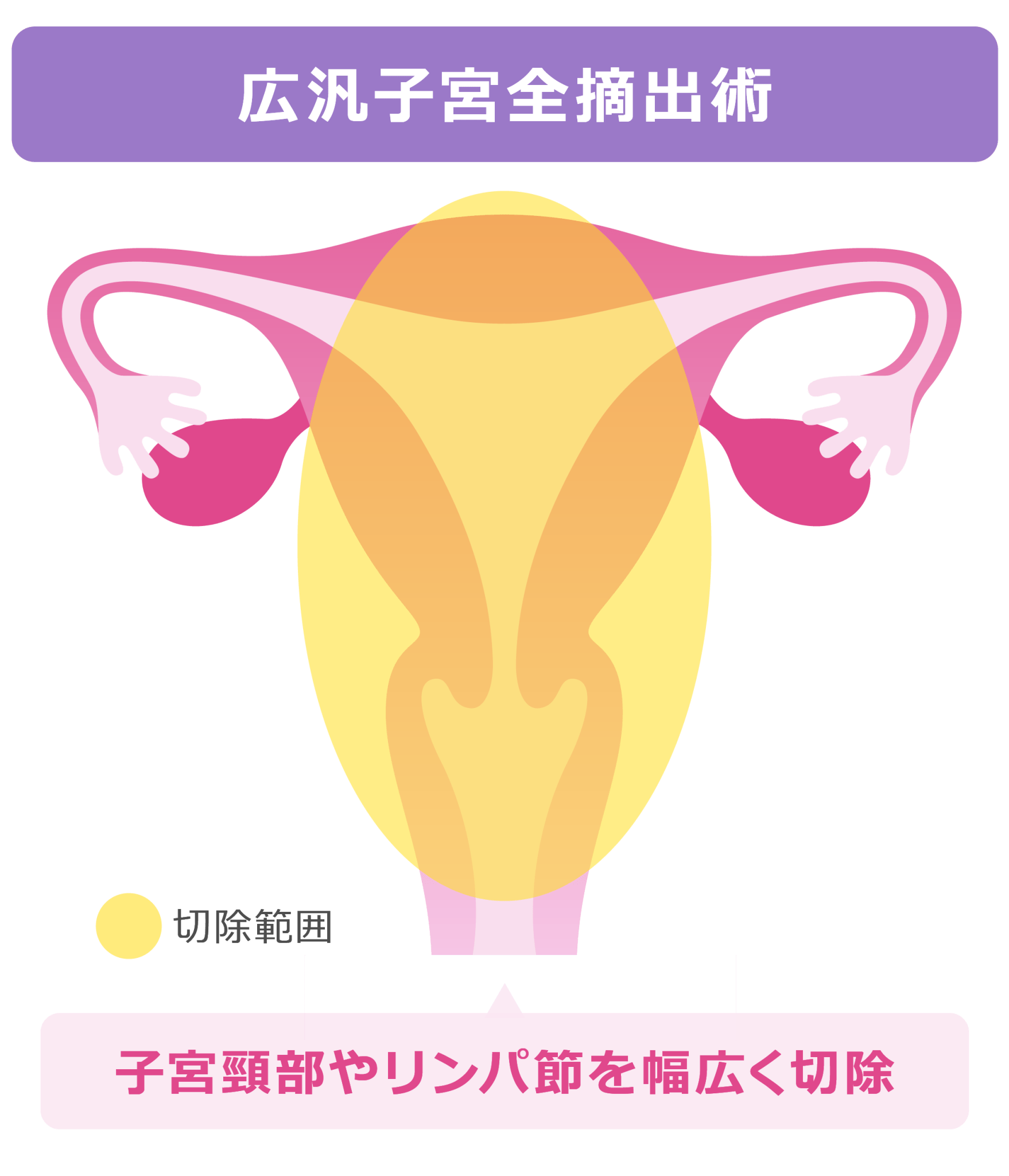 さらに進行したがんに対する治療法：広汎子宮全摘手術 | 子宮頸部やリンパ節を幅広く切除