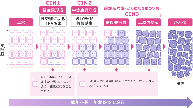 表：上皮細胞 | 正常→CIN1 - 軽度異形成 - 性交渉によるHPV感染（多くの場合、ウイルスは検査で見つからなくなり、正常に戻ることがある）→CIN2 - 中等度異形成 - 約10%が持続感染（一部は自然に正常に戻ることがあり、がんに進まないものもある）→CIN3 - 高度異形成（一部は自然に正常に戻ることがあり、がんに進まないものもある）→CIN3 - 上皮内がん（一部は自然に正常に戻ることがあり、がんに進まないものもある）→がん化（浸潤）| 数年～数十年かかって進行
